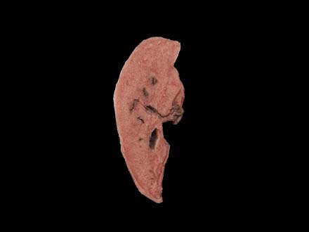 Pathlogy Liver Anatomy Model