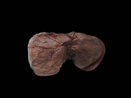 Pathological Liver Anatomical Model