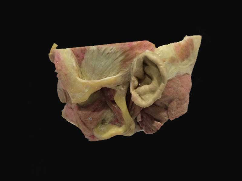 superficial muscles of mastication plastinated specimens