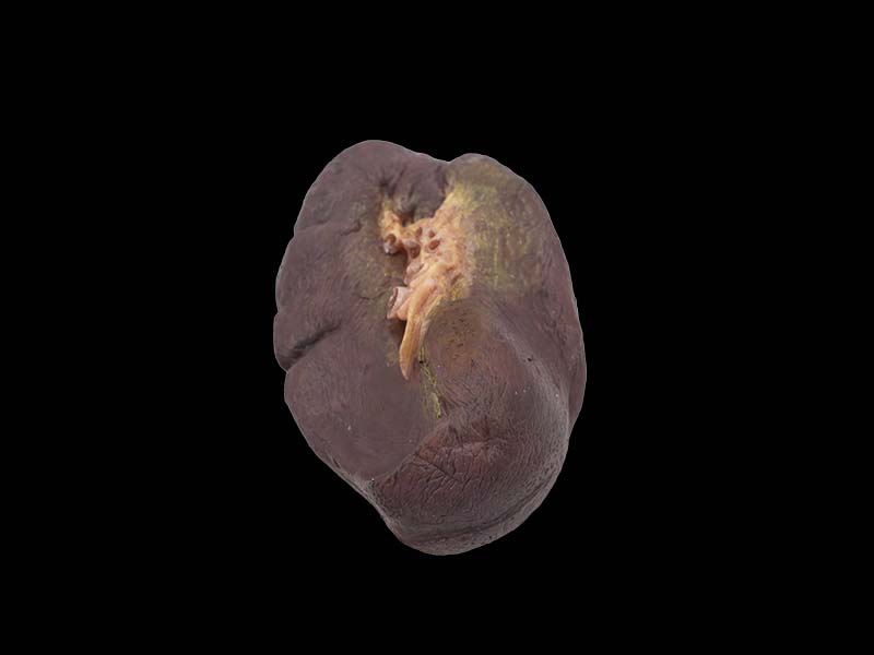 silicone pathological spleen anatomy model